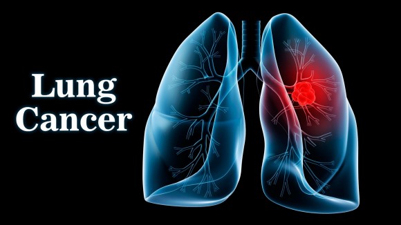 Chẩn đoán ung thư phổi khá khó khăn nhưng nó lại nhanh chóng cướp đi sinh mệnh con người.