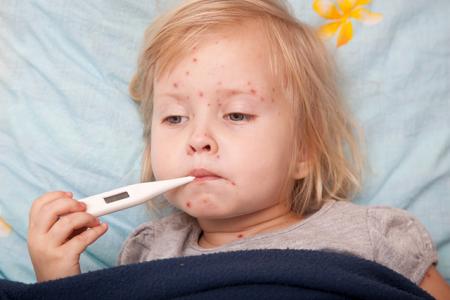 Bệnh sởi là bệnh truyền nhiễm gây dịch lưu hành phổ biến ở trẻ em
