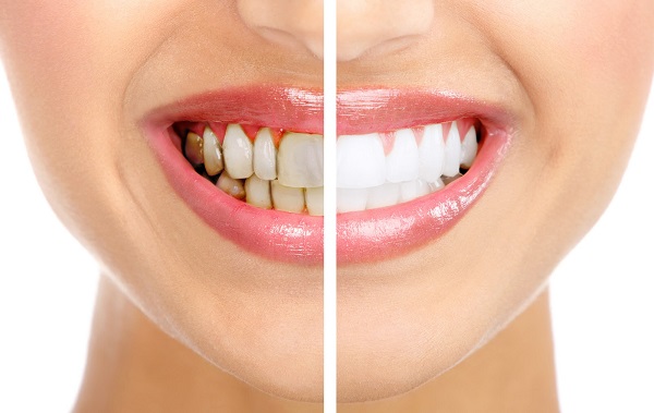 Nhiều yếu tố khiến răng bạn kém duyên