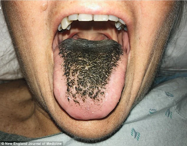 lưỡi chuyển dần màu đen vì dùng nhiều kháng sinh.