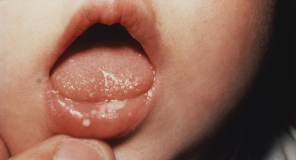 Có răng mới sinh dễ khiến lợi, môi trẻ tổn thương do trẻ có thói quen nghiến răng