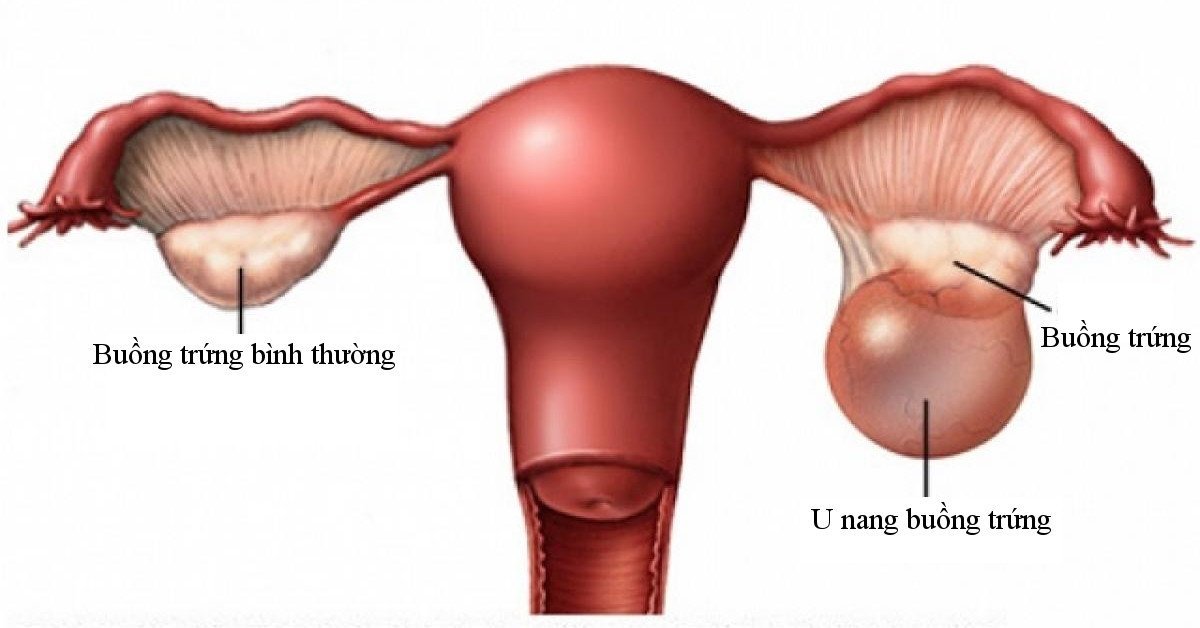 U nang buồng trứng không được điều trị kịp thời có thể dẫn đến ung thư buồng trứng và gây vô sinh. Ảnh minh họa