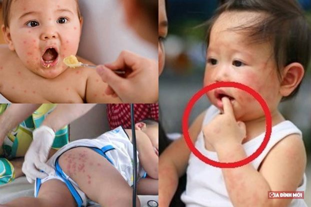 p/Vệ sinh cho trẻ không đúng cách, kiêng khem trong ăn uống khiến trẻ bị tay chân miệng gặp những biến chứng nguy hiểm. Ảnh minh họap/