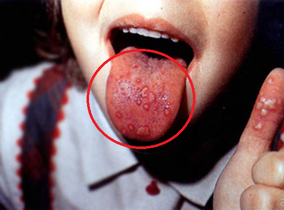 p/Những vết lở loét ở miệng làm trẻ bị tay chân miệng khó chịu, đau đớn, lười ăn và làm bệnh thêm nặng. Ảnh minh họap/