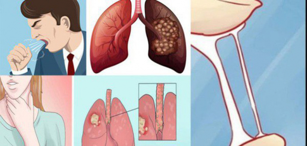 p/Ung thư phổi không có dấu hiệu đặc hiệu ở giai đoạn sớm nên phát hiện khó.p/