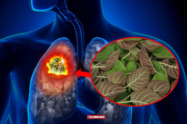p/Hiện nay không có phương pháp điều trị ung thư phổi bằng lá rau mơ với nước dừa, mật ong hay nước lọc. Ảnh minh họap/