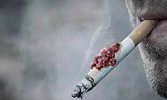  Tỷ lệ bệnh nhân ung thư phổi có hút thuốc lá chiếm tới hơn 90% 