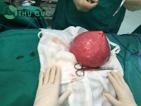 Bệnh viện Thu Cúc phẫu thuật khối u tử cung có kích thước như quả bưởip/