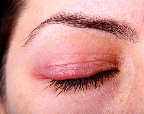 Mí mắt dễ dàng bị sưng tấy hoặc nhiễm bệnh nếu dùng chung bút kẻ mắt hay mascara.