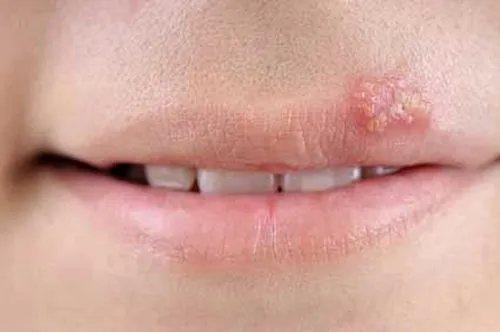 Sử dụng son môi chung có thể gây bệnh Hepes rất khó chữa.