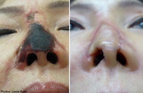 Tác hại của tiêm Filler nâng mũi với một phụ nữ người Singapore.