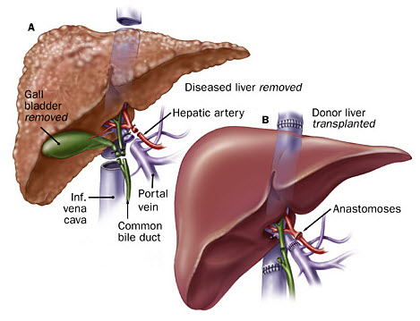 Ung thư gan thường do di căn từ cơ quan khác.