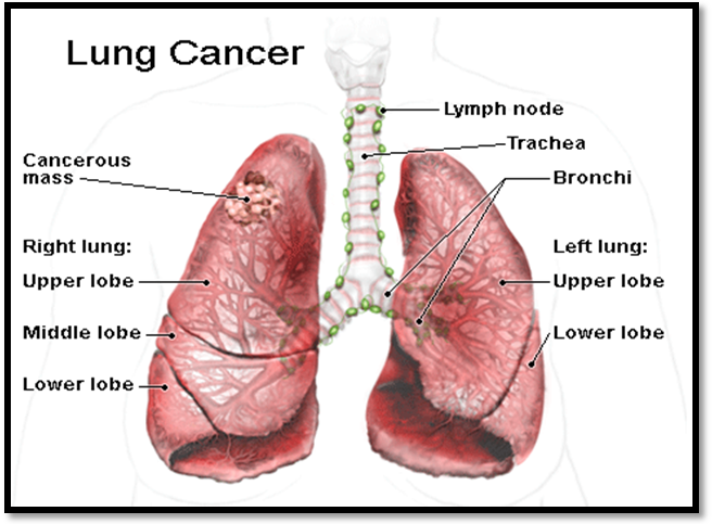 Ung thư phổi là loại ung thư nguy hiểm hàng đầu trên thế giới.