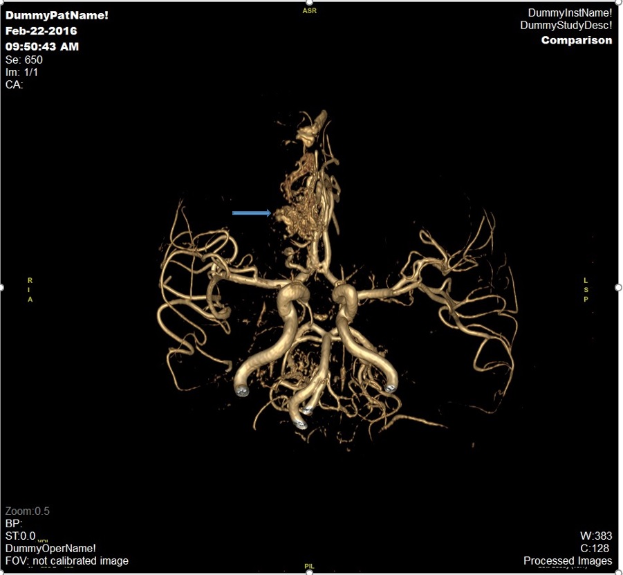 Hình ảnh dị dạng ống thông tĩnh mạch
