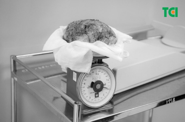 Khối u xơ tử cung “khủng” nặng đến 1.5kg (Ảnh TCI)